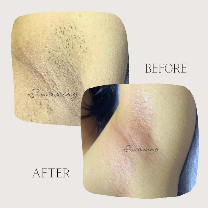 Triệt Lông Vùng Kín Nam TPHCM An Toàn, Kín Đáo - S Waxing Bình Thạnh #1 1 Triệt lông vùng kín nam TPHCM giúp vùng da nhạy cảm sạch sẽ, thông thoáng và tự tin hơn.