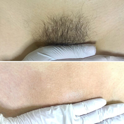 triệt lông bikini bảo lộc - wax lông bikini bảo lộc