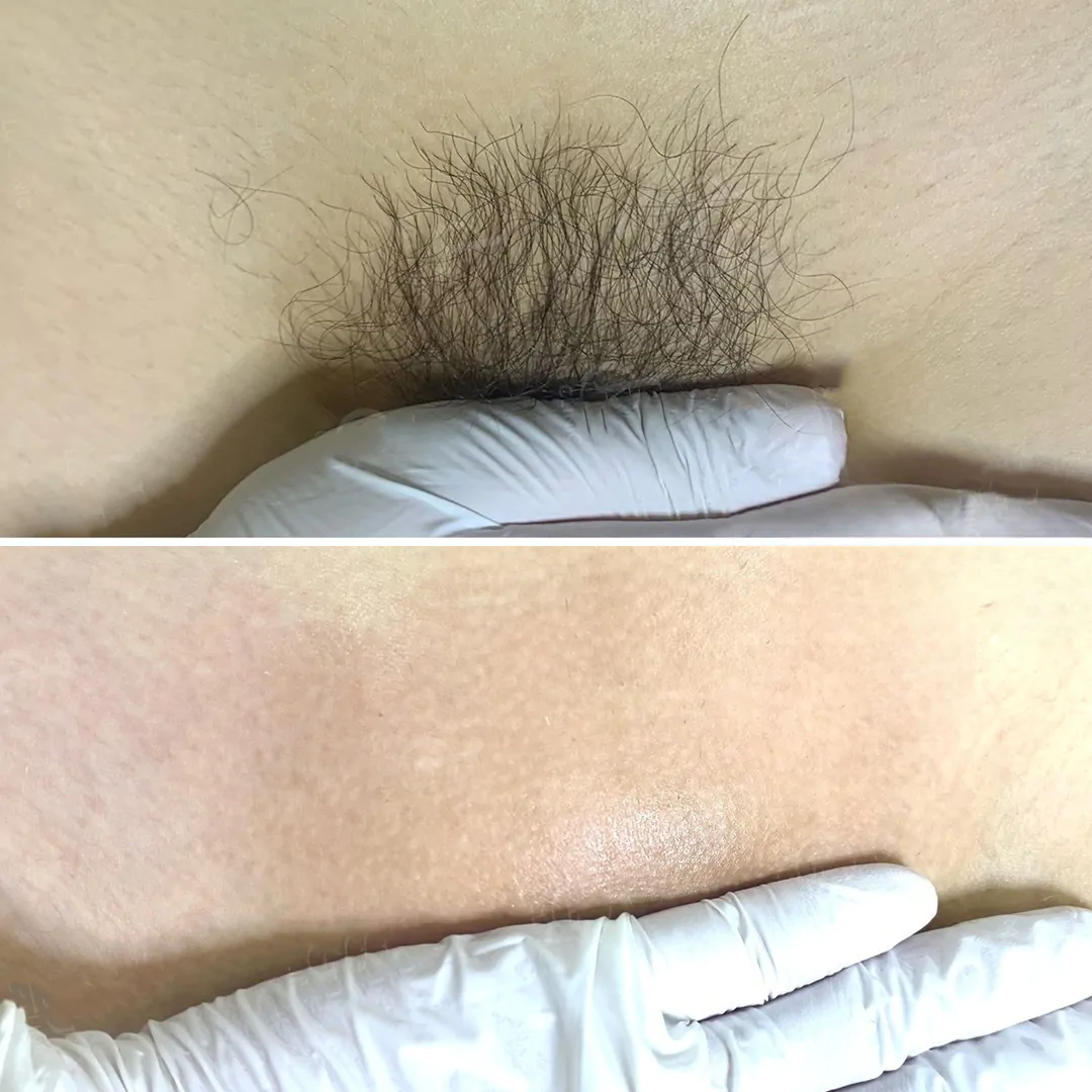 triệt lông bikini bảo lộc - wax lông bikini bảo lộc